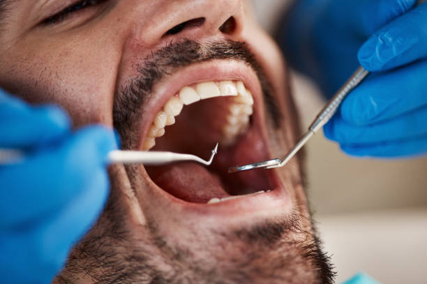 Best Emergency Tooth Extraction in Arden Arde, CA